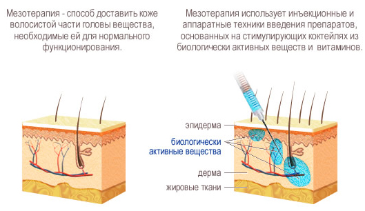 Dermahil for hair in mesotherapy. Composition, photos before and after, instructions for use