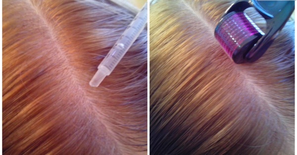 Dermahil per capelli in mesoterapia. Composizione, foto prima e dopo, istruzioni per l'uso