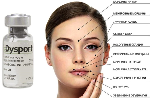 Dysport in cosmetologia. Foto prima e dopo l'uso, recensioni di cosmetologi e pazienti, prezzo