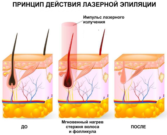 How to get rid of facial hair permanently. Cosmetological methods at home