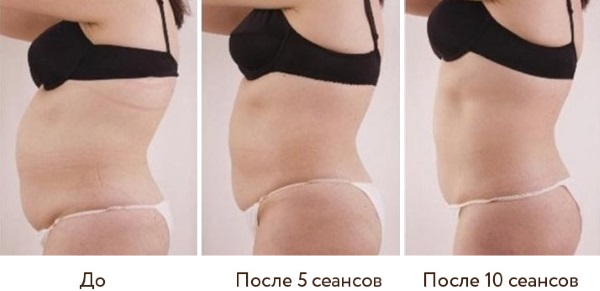 Cavitation. What is it, before and after photos, reviews, contraindications