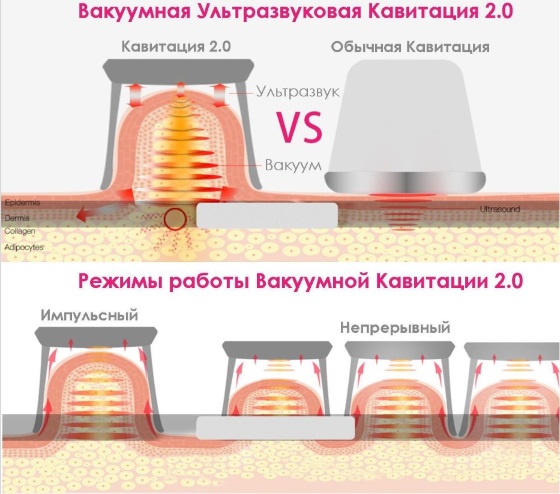 Cavitation. What is it, before and after photos, reviews, contraindications