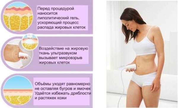 Cavitation. What is it, before and after photos, reviews, contraindications