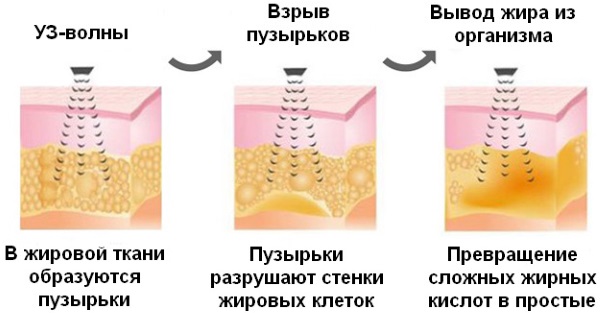 Cavitation. What is it, before and after photos, reviews, contraindications