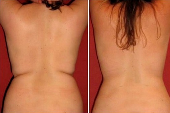 Cavitation. What is it, before and after photos, reviews, contraindications