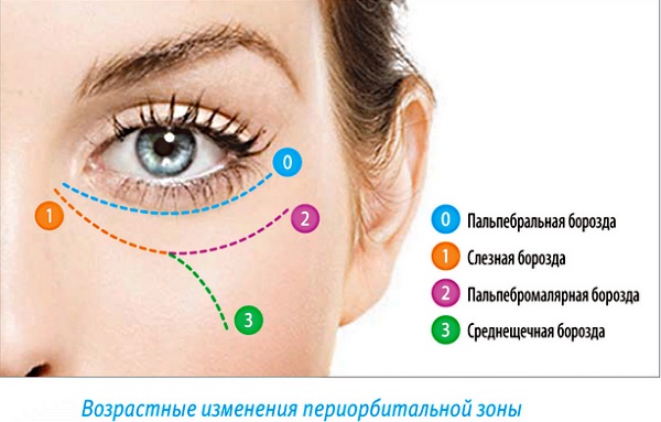 Contour plasty of the nasolacrimal groove. Before and after photos, complications, reviews