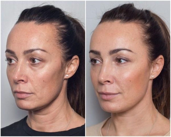 Contour plasty of the nasolacrimal groove. Before and after photos, complications, reviews