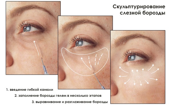 Contour plasty of the nasolacrimal groove. Before and after photos, complications, reviews