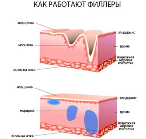 Contour plasty of the nasolacrimal groove. Before and after photos, complications, reviews