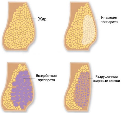 Liposuzione non chirurgica dell'addome. Foto prima e dopo laser, ultrasuoni, recensioni, prezzo