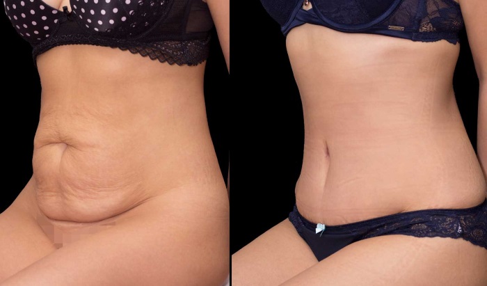 Mini-tummy tuck. Before and after photos, rehabilitation, results, price, reviews