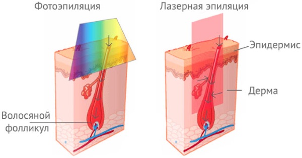 Neodymium laser for facial and body hair removal. Before and after photos, price, reviews