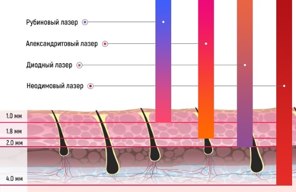 Neodymium laser for facial and body hair removal. Before and after photos, price, reviews