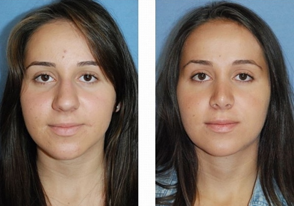 Girls have a wide nose. What to do, how to get rid of, rhinoplasty