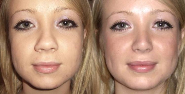 Girls have a wide nose. What to do, how to get rid of, rhinoplasty