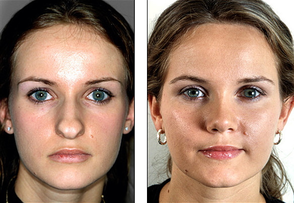 Girls have a wide nose. What to do, how to get rid of, rhinoplasty