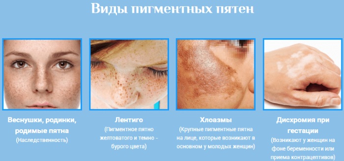 Remove pigmentation on the face at home quickly. Creams, folk remedies