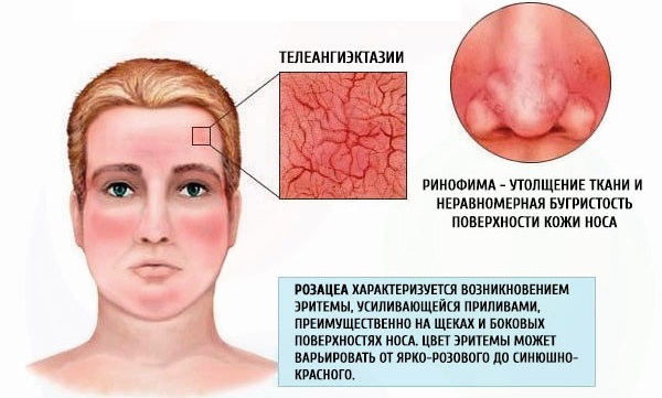 Azelaic acid. Preparations, instructions for use in cosmetology