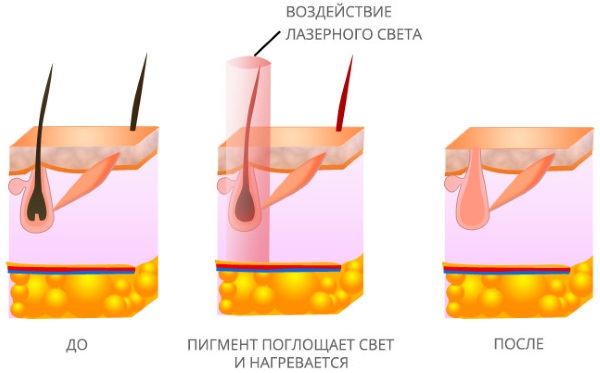 Depilation / hair removal at home with wax / sugar / honey, shugaring. How to do, recipes