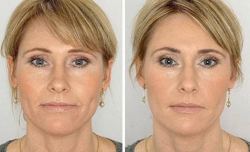 Facial contouring with fillers. Photo of how the oval correction is done, modeling, tightening, reinforcement