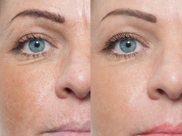 Mesotherapy around the eyes for dark circles, bruises, bags, edema. Before and after photos, price, reviews