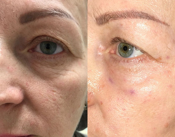 Mesotherapy around the eyes for dark circles, bruises, bags, edema. Before and after photos, price, reviews