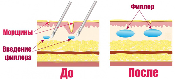 Mesovarton for face. Before and after photos, price, reviews, consequences