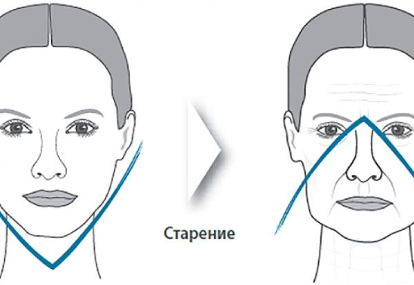 Surgical facelift. Price, how to choose a doctor, types of surgery