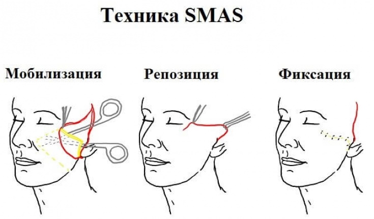 Surgical facelift. Price, how to choose a doctor, types of surgery