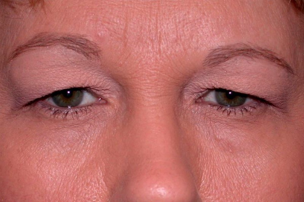 Lifting delle palpebre chirurgico e non chirurgico. Blefaroplastica circolare, mesotelaio, laser, botox. Foto, prezzi