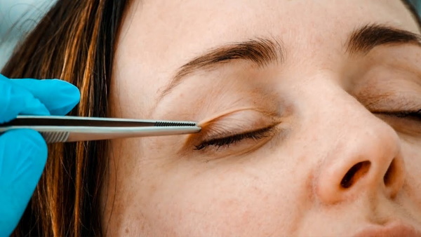 Surgical and non-surgical eyelid lift. Circular blepharoplasty, mesothreads, laser, botox. Photos, prices