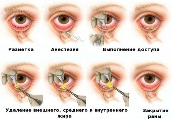 Lifting delle palpebre chirurgico e non chirurgico. Blefaroplastica circolare, mesotelaio, laser, botox. Foto, prezzi