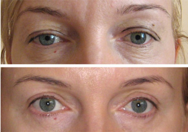 Surgical and non-surgical eyelid lift. Circular blepharoplasty, mesothreads, laser, botox. Photos, prices