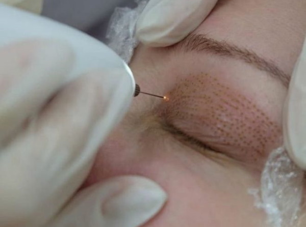 Surgical and non-surgical eyelid lift. Circular blepharoplasty, mesothreads, laser, botox. Photos, prices