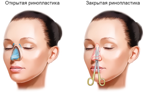 Rinoplastica del naso: chiusa, aperta, ricostruttiva, iniezione, laser. Prezzo e recensioni