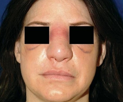 Rhinoplasty of the nose: closed, open, reconstructive, injection, laser. Price and reviews