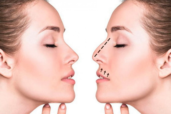 Rhinoplasty of the nose: closed, open, reconstructive, injection, laser. Price and reviews