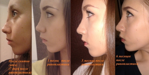 Rhinoplasty of the nose: closed, open, reconstructive, injection, laser. Price and reviews