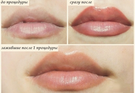 Lip tattoo. Before and after photos, consequences, reviews