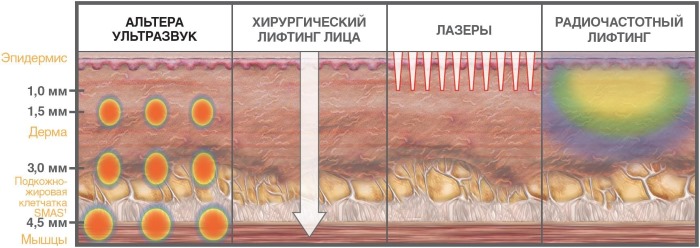 Ulthera (Altera) therapy in hardware cosmetology. Before and after photos, price, reviews