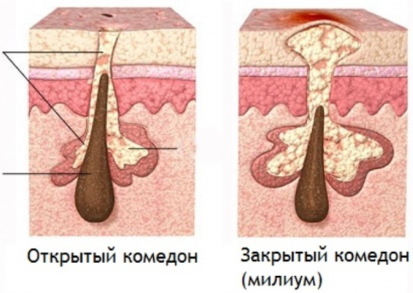 White spots under the eyes. What is it, the reasons for its appearance, how to get rid