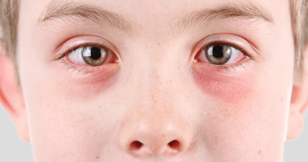 White spots under the eyes. What is it, the reasons for its appearance, how to get rid