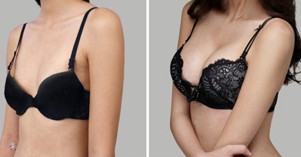 Breast augmentation surgery. Photos of girls with big breasts, results, possible complications