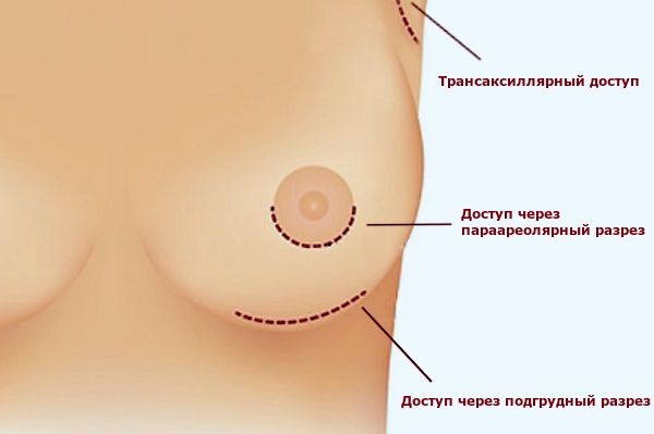 Breast augmentation surgery. Photos of girls with big breasts, results, possible complications