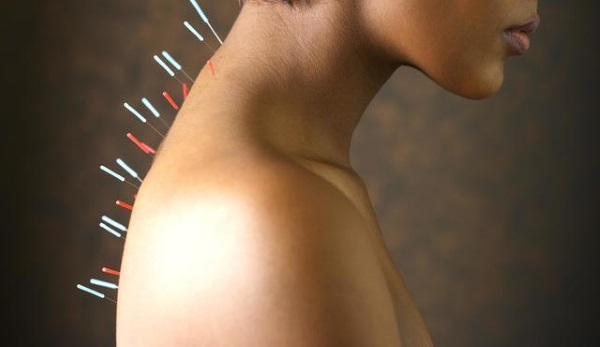 Acupuncture for weight loss. How it is done in the ear, on the body, the benefits and harms of acupuncture, reviews