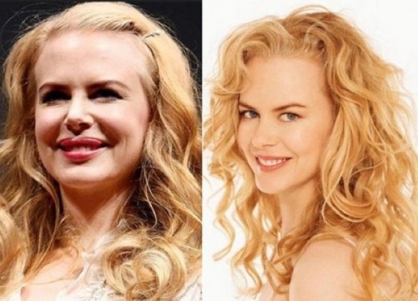 Nicole Kidman. Le foto prima e dopo la chirurgia plastica, in gioventù, ora, figurano