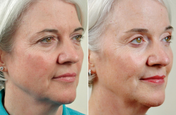 Cantopexy - what is it, types of eyelid lift, before and after photos, price, reviews