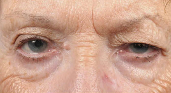 Cantopexy - what is it, types of eyelid lift, before and after photos, price, reviews