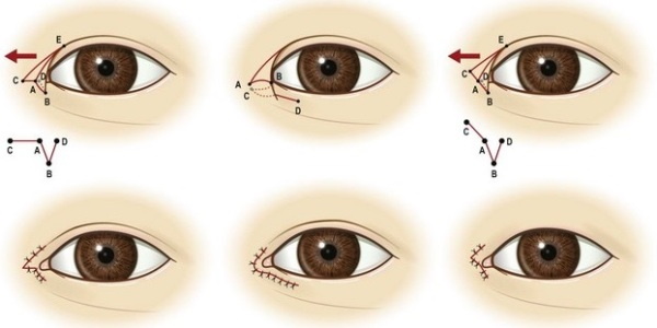 Cantopexy: che cos'è, tipi di sollevamento delle palpebre, foto prima e dopo, prezzo, recensioni