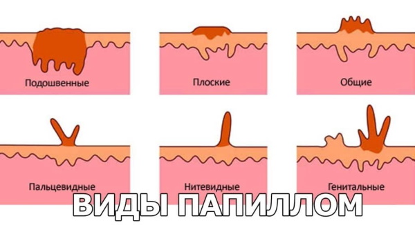 Removal of papillomas on the face with a laser, nitrogen, radio wave method, ointments from a pharmacy, folk remedies